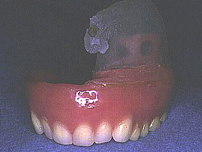 左側上顎洞がん摘出後に制作された上顎義歯